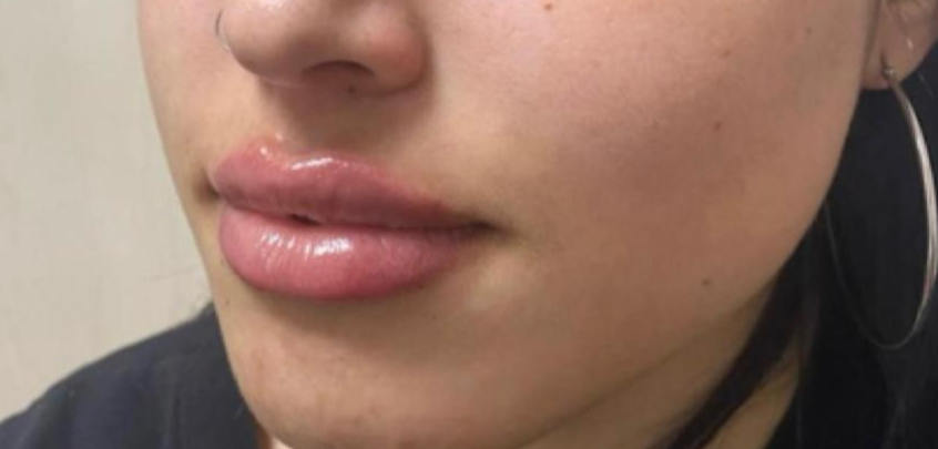 Renovación facial con naturalidad